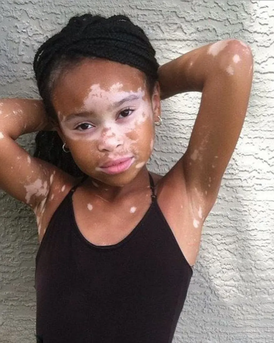 Advanced Vitiligo Care at Cinch Clinics